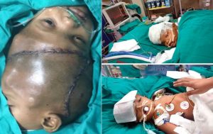 Alhamdulillah, Bayi Dempet Kepala Akhirnya Bisa Tidur Terpisah