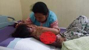 Minum Obat Berharap Sembuh, Tubuh Bocah Ini Justru Melepuh