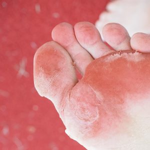 5 Hal Jorok yang Terjadi pada Kaki Tak Terawat