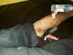 Ditikam Pakai Ekor Ikan Pari, Nelayan di Bone Kritis