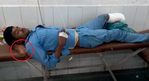 Potongan Kaki Dijadikan Bantal Pasien Amputasi, Dua Dokter Dipecat