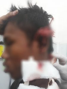 Buruh Bangunan Aniaya Remaja, Anak Panah Masih Tertancap Ditelinga