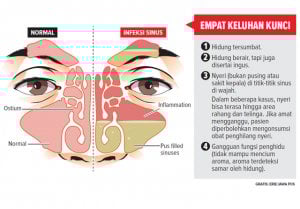 Rhinosinusitis yang Mirip Pilek, Tak Semua Harus Operasi