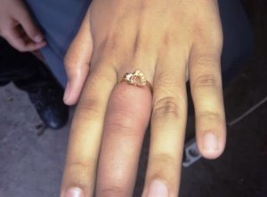 Panik Cincin di Jarinya Tak Bisa Lepas, Gadis Ini Datangi Damkar