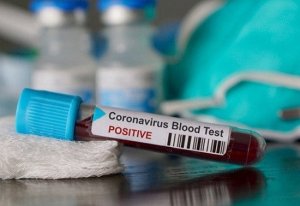 Penderita HIV/AIDS PDP Covid-19, Mengaku Sesak Napas