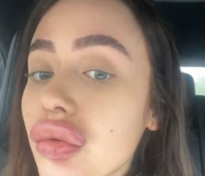 Gara-Gara Suntik Filler, Bibir Pramugari Ini Jontor 3 Kali Lipat