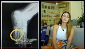 Aku Bodoh Banget, Cerita Luna Maya soal Tulang Kakinya yang Retak