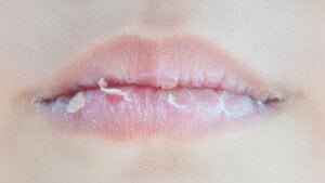 Bibir Kering Saat Puasa? Nih Tips Merawatnya