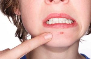 Jangan Buru-buru Minum Obat, Bisul Langsung Kempes dengan Herbal Ini