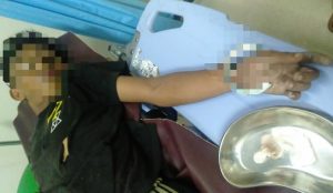 Bocah yang Tertusuk Besi Pagar Jalani Operasi