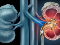 Dokter Spesialis Urologi Ungkap Penyebab Batu Ginjal Bisa Muncul Kembali Setelah Operasi 