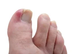 Cegah Cantengan, Rasa Sakit yang Tak Tertahankan di Jempol Kaki