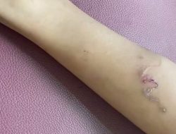 Fenomena Larva Cacing Menginfeksi Kulit Manusia, Pentingnya Rutin Cuci Tangan dan Kaki Pakai Sabun